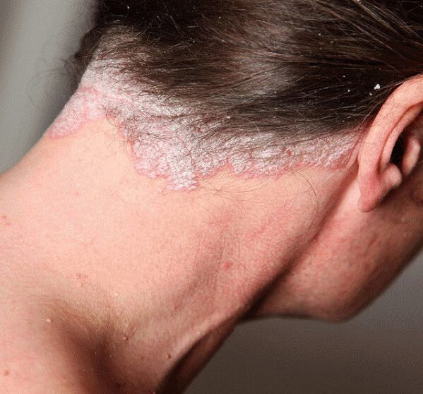 Comment traiter le psoriasis