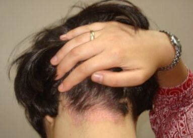 Psoriasis sur la tête