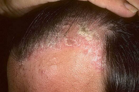 Symptômes du psoriasis