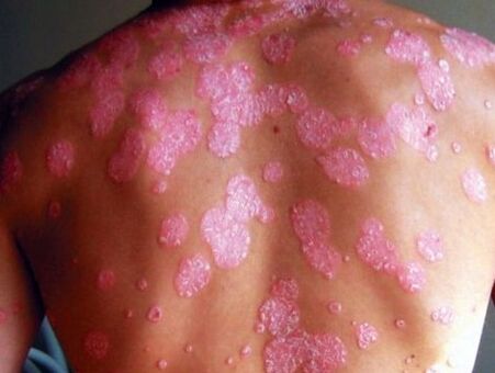 Maladie psoriatique
