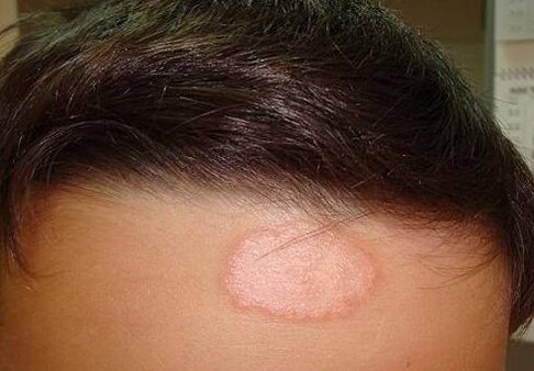 Spot psoriatique