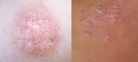 Psoriasis dans les premiers stades